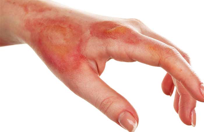 آسیب پوستی | جراحی | سوختگی