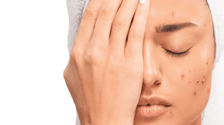 قاتل جوش صورت خانگی (3 بهترین روش+ نکات مهم)