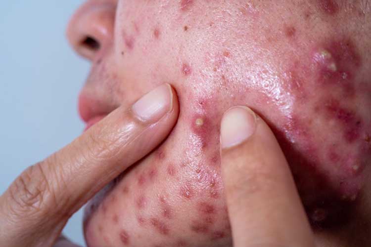 باورهای غلط رایج درباره جوش صورت